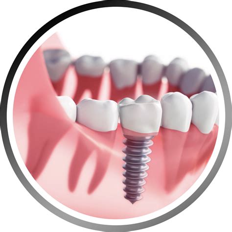 Dental Implants Melbourne Genesis Dentists