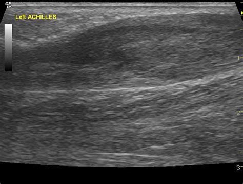 Ultrasound Evaluation Of Achilles Tendinopathy Journal Of Medical Imaging And Radiation Sciences