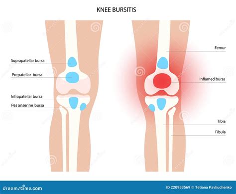 Bursitis Inflammation Concept Stock Vector - Illustration of injury ...