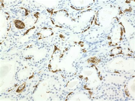 Atypical Adenomatous Hyperplasia 34be12 Immunostain