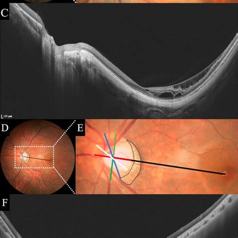 Fundus Photography And Ss Oct Images Of The Mtm And Nmtm Groups Ac