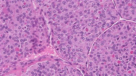 Poorly Differentiated Thyroid Carcinoma Atlas Of Pathology