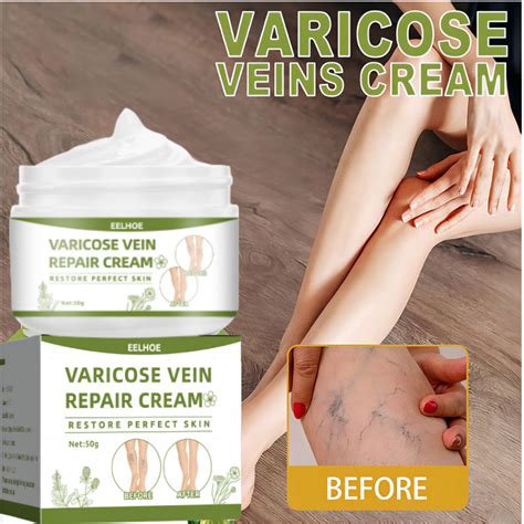 Varicose Vein Remover Cream Varicose Veins Treatment Eliminate Varicose