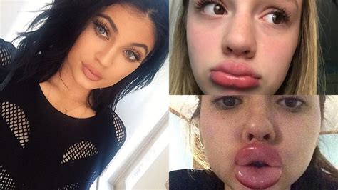 Kylie Jenner Challenge Leads To Disastrous Teen Lip Diy