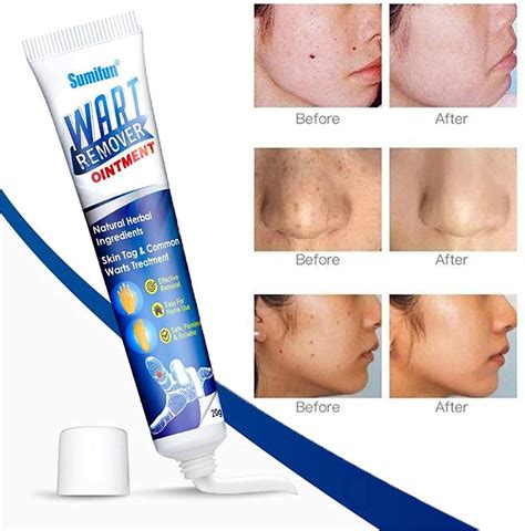 Wart Removal Treatment Cream Plantar Flat Filiform Periungual Common Skin Tag Ebay