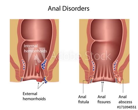 Anal Disorders Hemorrhoids Fistula Fissures Abscess Buy This Stock Illustration And