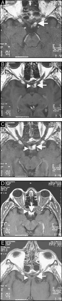 Gadolinium Enhanced Axial Magnetic Resonance Imaging Scans Before And