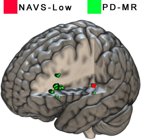 areas   vlsm  syntactic deficits based  hierarchical