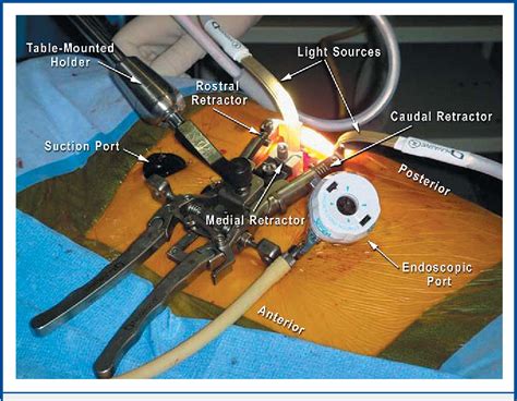 Figure From Video Assisted Thoracoscopic Surgery Combined With A