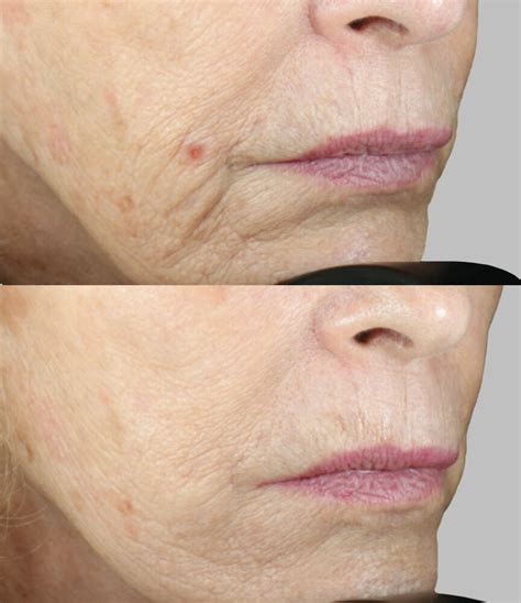 The Difference Between Rf Microneedling And Traditional Microneedling