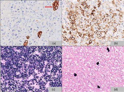 Immunohistochemistry A Ck Was Negative In Tumor Cells While Entrapped