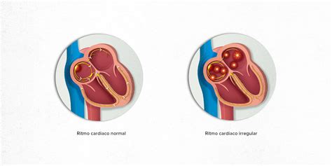 Qué es la Fibrilación Auricular Hospital Clínic Barcelona