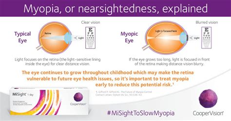 Myopia - Nearsightedness - Optometrist - Milton, ON