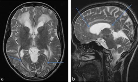 MRI - a Bilaterally preserved myelination of the optic radiation; b ...