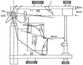 Graphical overlay of ceph tracing and articulator depicting the common... | Download Scientific ...