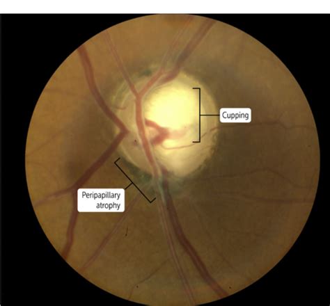 Common Noninfective Eye Disorders Flashcards Quizlet