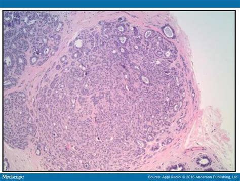 Sclerosing Adenosis Mimicking Malignant Lesion On Breast MRI