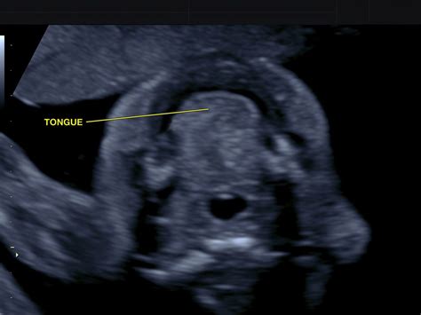 SMFM Fetal Anomalies Consult Series 1 Facial Anomalies American