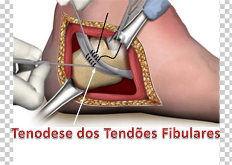 Tendon Thumb Peroneus Brevis Peroneus Longus Foot Tubular Hand Foot Hot Sex Picture