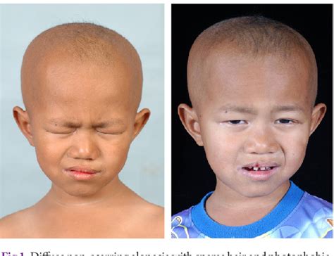 Figure From Ichthyosis Follicularis With Atrichia And Photophobia