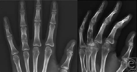 Radiographs Of The Left Hand With An Expansile Lytic Lesion Within The