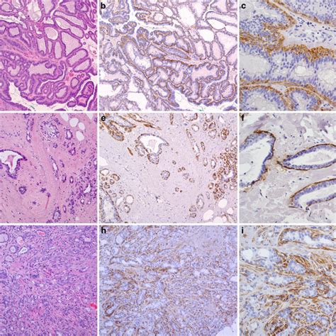 Ngfr Expression In Benign Breast Lesions Low Power Magnification Of A