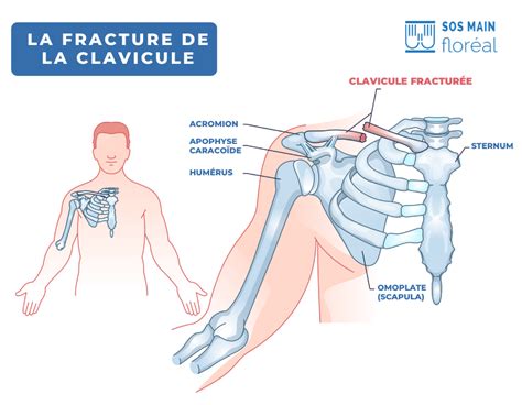 Fracture De La Clavicule Diagnostic Traitement Dr Meryl Dahan