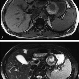 A Axial View Of Abdominal CT With IV Contrast Shows A 5 2 Cm