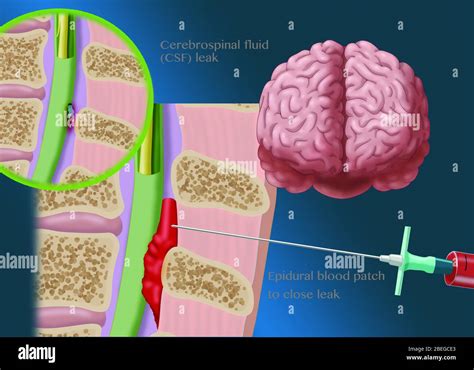 Epidural Blood Patch Procedure Illustration Stock Photo Alamy