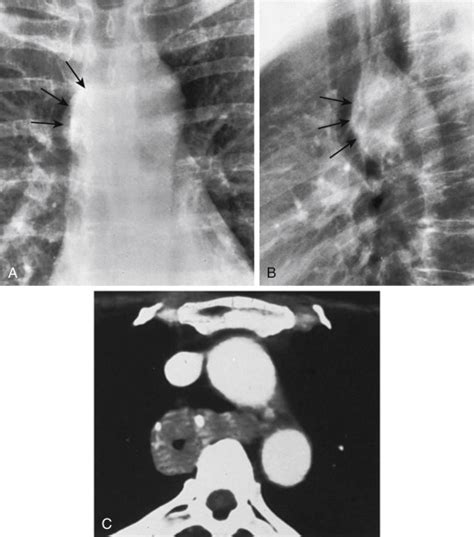 Middle Mediastinal Mass Radiology Key