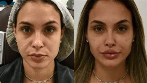 Ex Bbb Sarah Andrade Faz Harmoniza O Facial Veja Antes E Depois