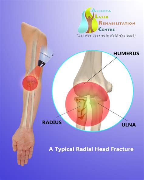 Case Study: Radial Head Fracture Heals With Laser Therapy