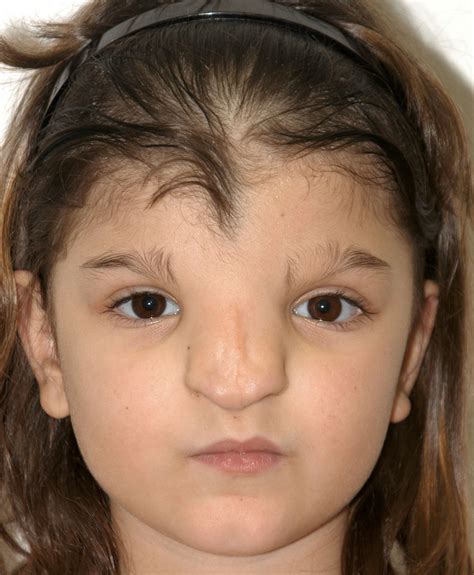 Craniofrontonasal Dysplasia Hellenic Craniofacial Center