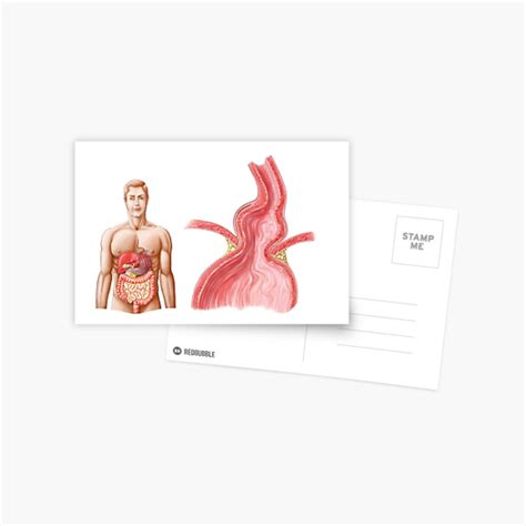 Medical Illustration Of A Hiatal Hernia In The Upper Part Of The