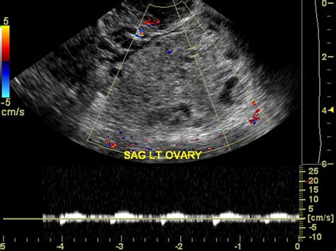 Pearls And Pitfalls In Diagnosis Of Ovarian Torsion Radiographics