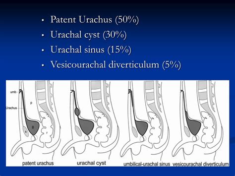 Ppt Pediatric Umbilical Abnormalities Powerpoint Presentation Free