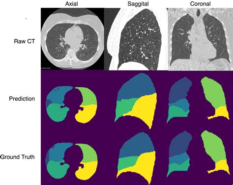 Automatic Pulmonary Lobe Segmentation Using Deep Learning Deepai