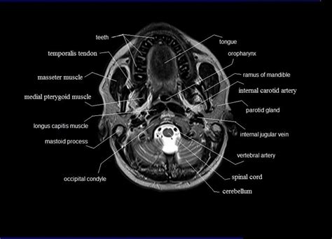 Mri Neck Anatomy Free Mri Axial Neck Cross Sectional Anatomy With Images Radiology