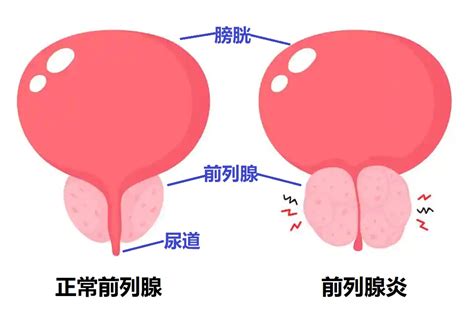 前列腺 男性独有的神秘地带为你解答前列腺炎迷思 健康时尚 Good Health