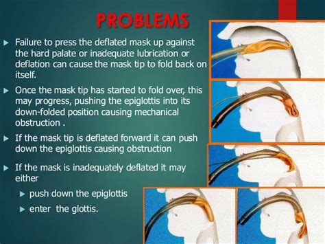 Supraglottic airway device