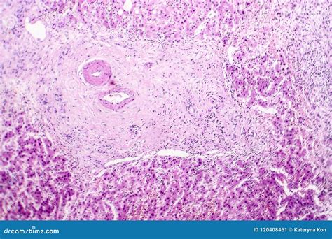 Histopathology Of Liver Abscess Coloso