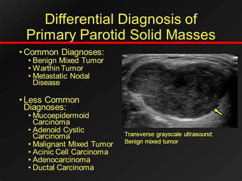 Parotid Gland Tumor Ultrasound