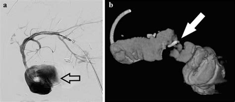 Roux limb obstruction in a 3-year-old boy post split-liver transplant ...