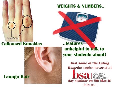 Russells Sign Bulimia