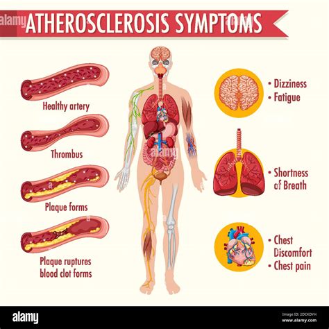Stages Of Atherosclerosis Information Infographic Illustration Stock