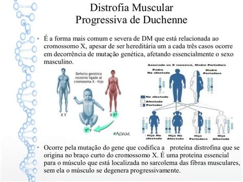 Distrofia Muscular Progressiva De Duchenne