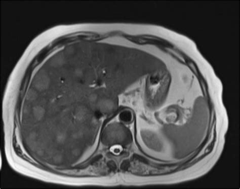 Hepatic Magnetic Resonance Imaging Mri Showing An Enlarged Liver Download Scientific Diagram