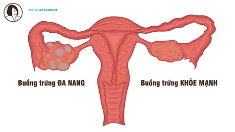 Buồng Trứng Đa Nang Dấu Hiệu Triệu Chứng Cách Điều Trị