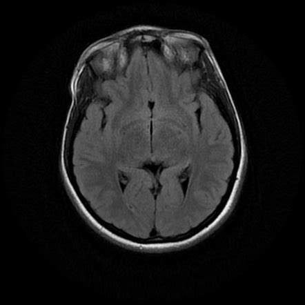 Intracranial Epidermoid Cyst Image Radiopaedia Org