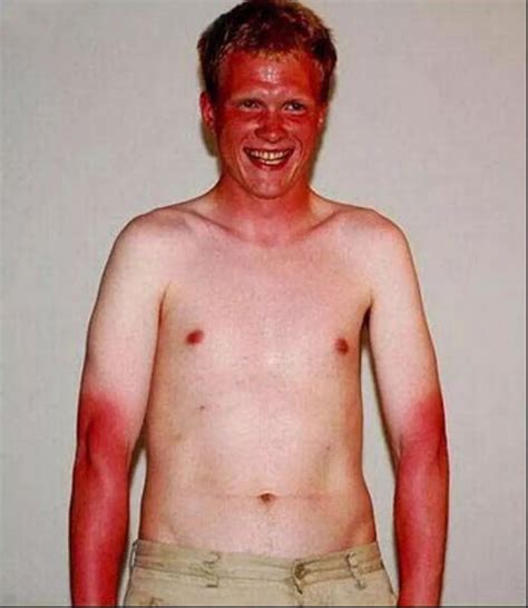 Worst And Funniest Sunburn Ever Mirror Online